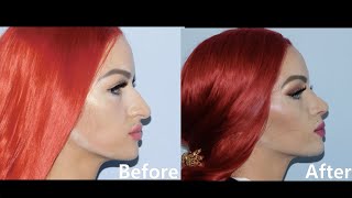 Rhinoplasty and Cast Removal with Dr. Jonathan Pontell