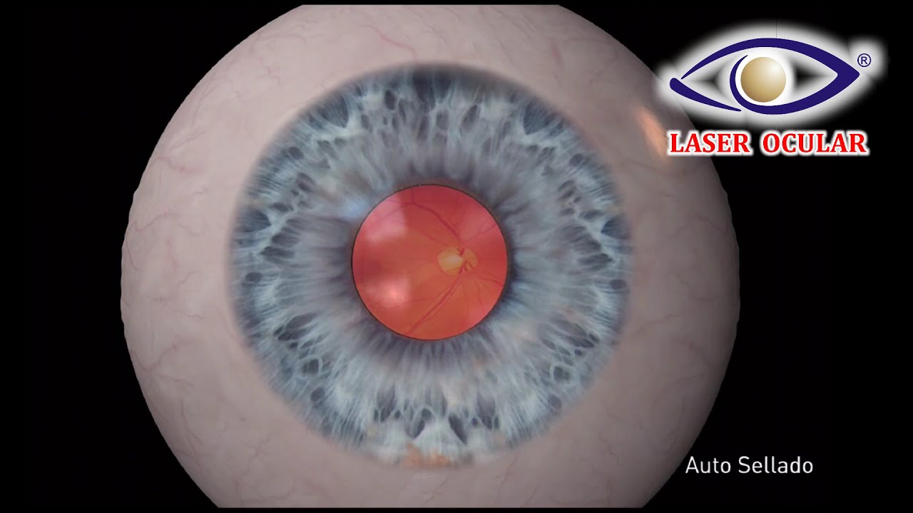 🥇 - Cirugía de Cataratas | LÁSER OCULAR ® - Clínica de Ojos - YouTube