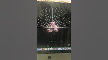 knee joint 3D ct scan knee joint post surgery for #video #viral #trending