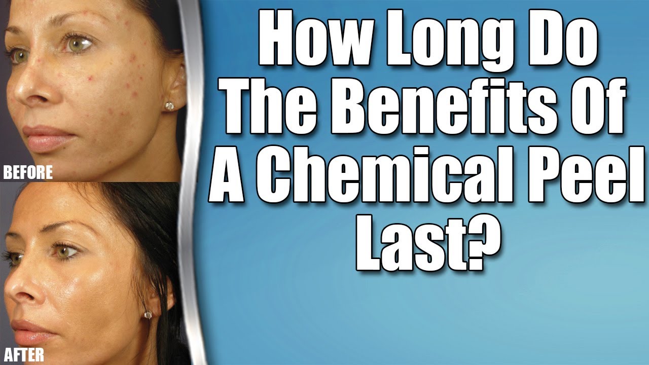 Chemical Peel Brighton: How Long Do The Effects Of Chemical Peels Last?