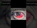 Subconjunctival hemorrhage#eyehospital #eyes #optometry #eyecare #opthalmology #clinical #eyecatchy