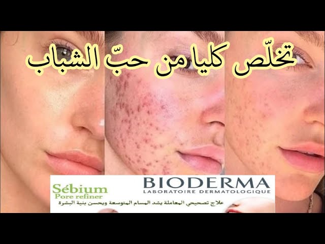 أفضل حل وعلاج لحب الشباب والرؤوس السوداء من شركة  Bioderma | ملتقى الأساتذة والأحبة