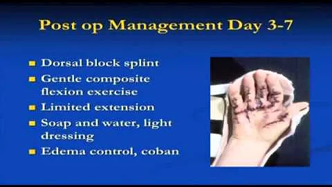 Terri Skirven OTR/L CHT, "Hand therapy for Dupuytr...
