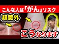 放置危険 その皮膚のブツブツ がん のサインです 知らないと後悔する 5つの病変 現役医師が蕁麻疹や帯状疱疹と発がんリスクを解説 放置危険 その皮膚のブツブツ がん のサインです 知らないと後悔する 5つの病変 現役医師が蕁麻疹や帯状疱疹と発がんリスクを解説