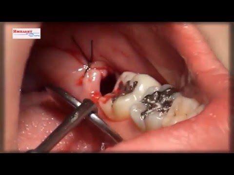 Tooth extraction - dentistry