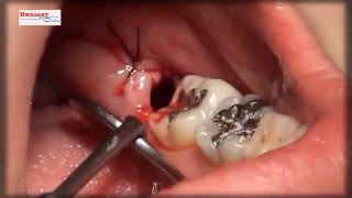 Удаление зуба - мудрости в стоматологии (хирургия). Zahnextraktion - Weisheit in der Zahnheilkunde(Удаление зуба мудрости 2, стоматология 