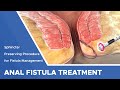 Closure of fistula tract with laser