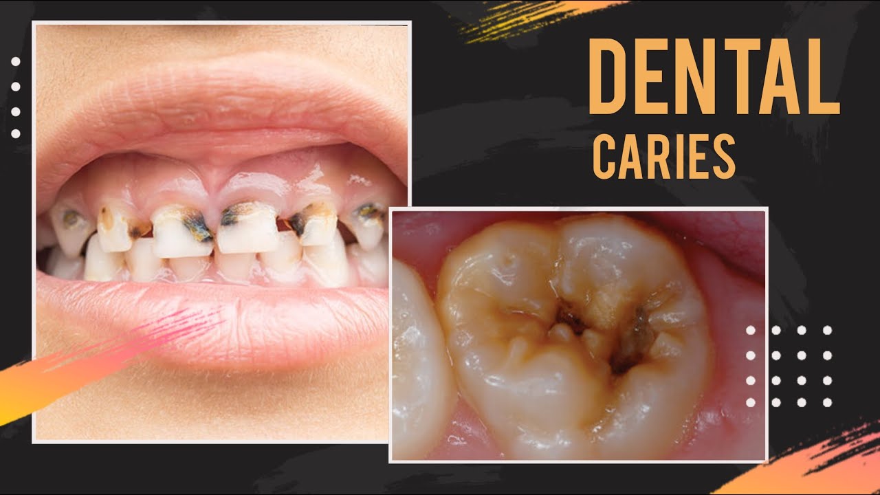 Dental caries Oral Pathology ppt share Dental Clinic