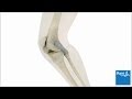 How knee arthroscopy is carried out