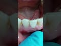 НОС ОКИБАТИ БУЛГАН ТИШ ТОШЛАРИНИ ТОЗАЛАТИШ ЗАРАР !  ШУ ТУГРИМИ ? +79636579707 ВАТСАП