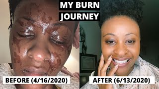MY BURN JOURNEY | 1ST & 2ND DEGREE BURNS | SPIRITUAL GROWTH | SELF LOVE