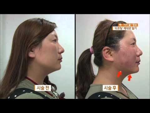 [Smart Reporter, Sweet Tips] The "Younger-Looking" Craze: A Careful Look at Lifting Procedures