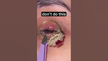 Kiss Your Stye Good Bye 