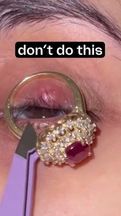 Kiss Your Stye Good-Bye 👋