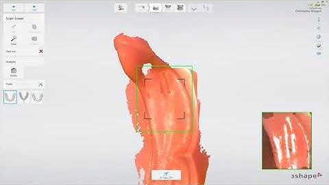 Intraoral Scanning Workflow for Edentulous Patients (3Shape TRIOS)