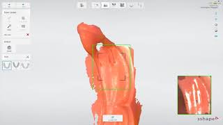 Intraoral Scanning Workflow for Edentulous Patients (3Shape TRIOS)