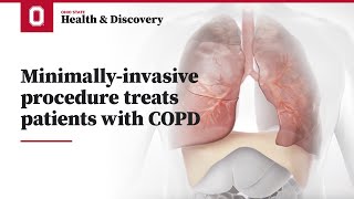 Minimally-invasive procedure treats patients with COPD | Ohio State Medical Center