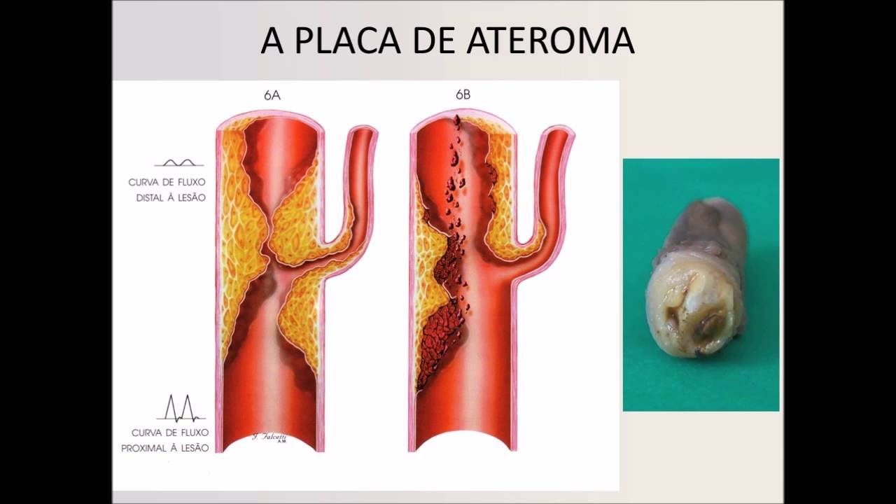 DOENÇA ARTERIAL PERIFÉRICA Prof ABDO FARRET NETO UFRN angiologia e médico de quê