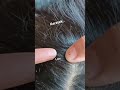 lice infestation #headliceremoval #licecomb #headlice #headlicetreatment #hairlice #haircare #hair