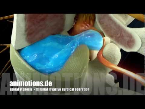 Spinal Stenosis Surgery (3D Animation)