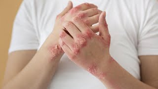 The Ultimate Guide to Managing Psoriasis | A Healthier Future