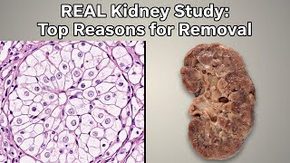 Kidney Under Microscope Shocking Reasons For Nephrectomy In India Pathology Review