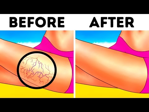 8 Natural Ways to Fight Spider and Varicose Veins