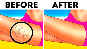 What does it mean when your veins are really blue?