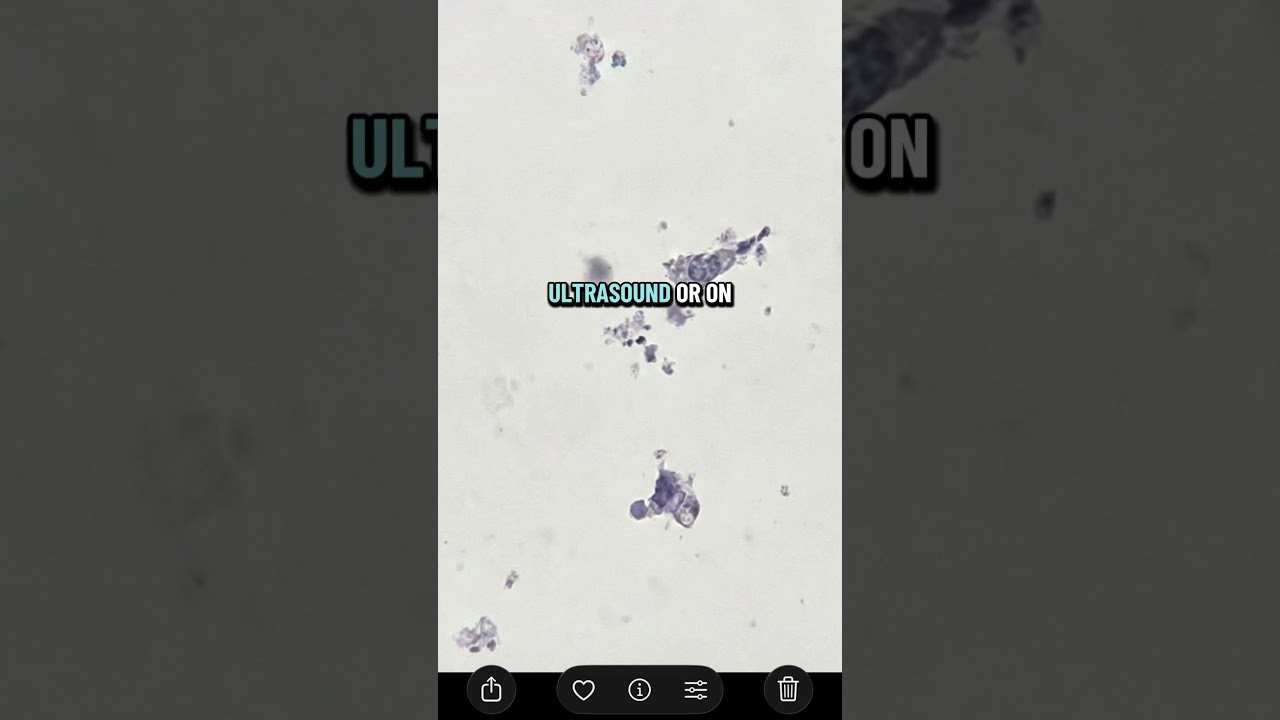 Explaining complete pathologic response 