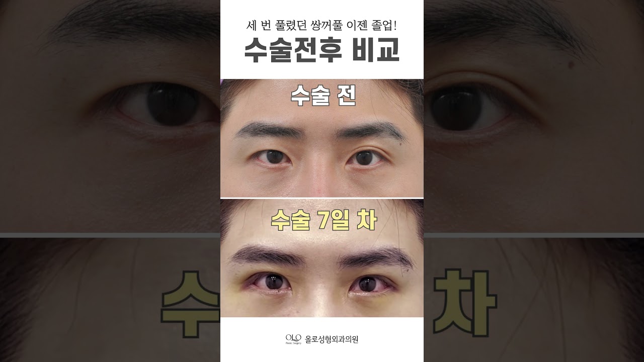 [OLLO整形外科診所] 三次脫落的 #雙眼皮 #OLLO整形外科 #畢業 現在結束啦~ #雙眼皮修復手術 成果簡直絕了！ #輕鬆 #最後 #短片