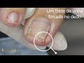 Isso Estava Enterrado no Dedo Dela #satisfying #nails