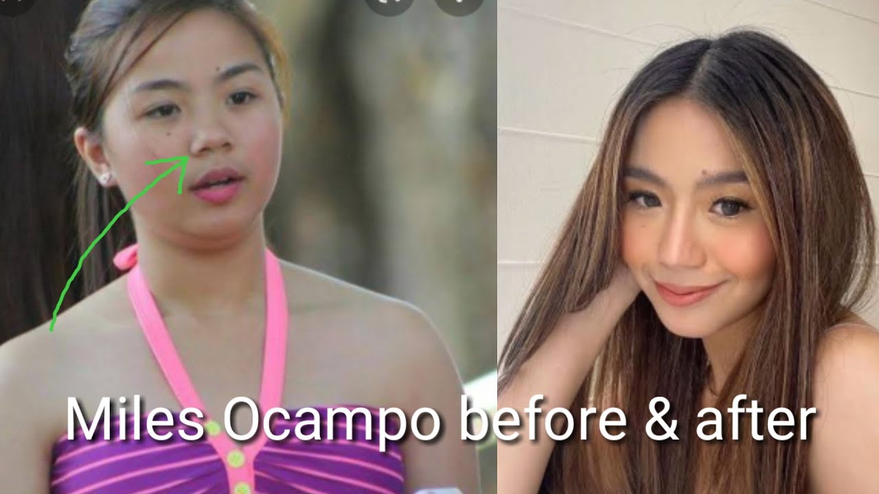 Miles Ocampo before and after. Camille Tan real name nagparetoke ba ng