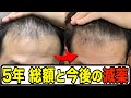 【AGA 治療 費用】5年間の総額と今後の減薬について【クリニック32社 価格比較】