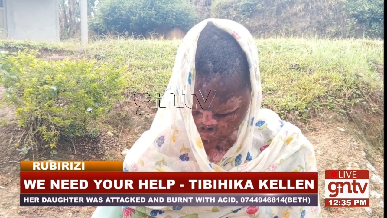 16-YEAR-OLD ACID ATTACK VICTIM SEEKS FOR HELP