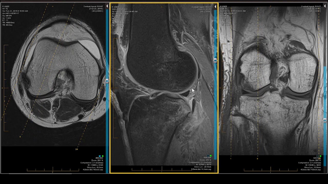 New Knee MRI - Case Review: Twisting Injury