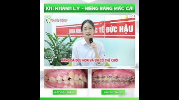 NIỀNG RĂNG- HÀNH TRÌNH NIỀNG RĂNG THAY ĐỔI NỤ CƯỜI, THAY ĐỔI DIỆN MẠO #nhakhoaduchau #niengrang