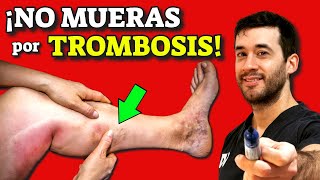 ¡NO MUERAS de TROMBOSIS y COÁGULOS! |GUÍA MÁS COMPLETA de TROMBOSIS VENOSA PROFUNDA
