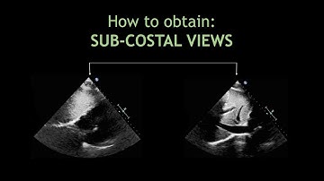 How to obtain: SUB-COSTAL VIEWS! (Echocardiography)