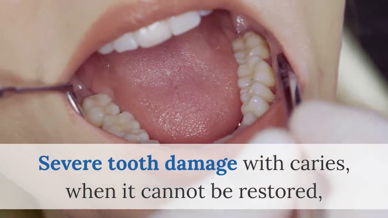 Dentist tooth extraction Brooklyn (347) 7045970 Tooth Extraction