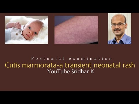 Video: Poate fi normală pielea pestriță la bebeluși?