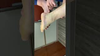 Ruptured Achilles treated non-surgically with a cast, Part 1 by Timonium Foot and Ankle Center 4,759 views 1 year ago 1 minute, 51 seconds