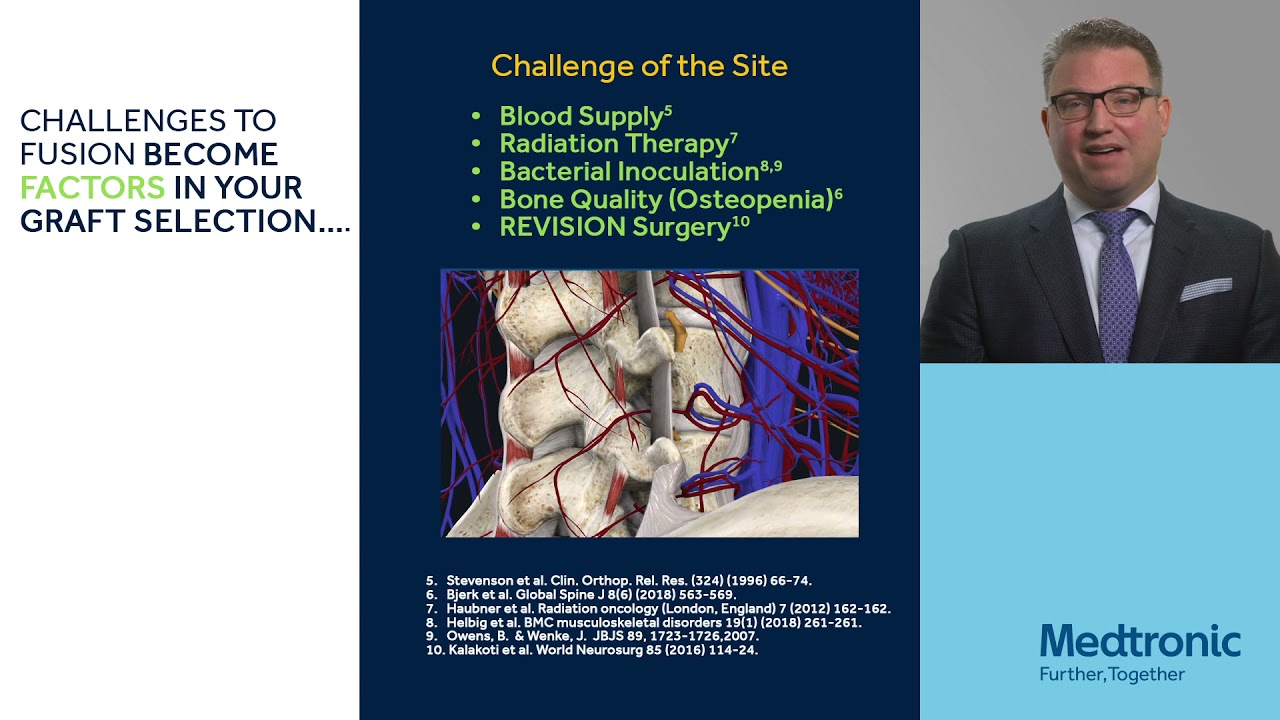 Faculty Perspective: Bone Graft Selection Strategy