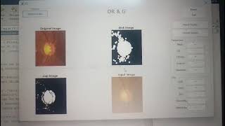 Diabetic Retinopathy Detection Project Demo