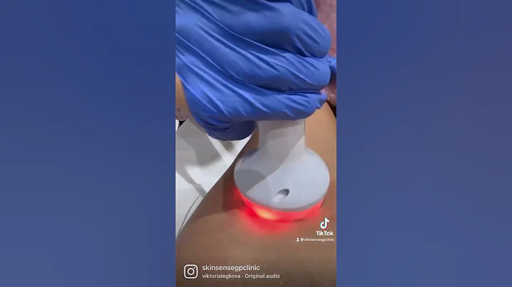 Radio Frequency Treatment💪🏼