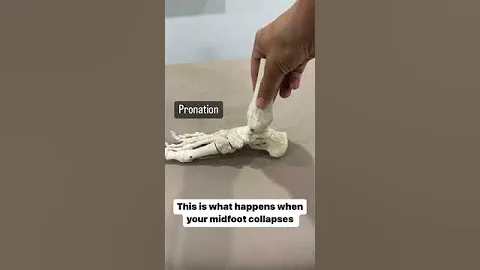 This is what happens when you have flat feet