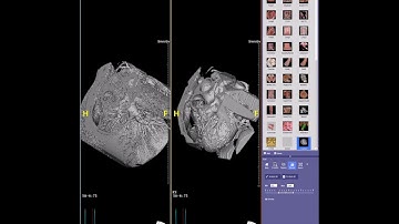 Denoising prior to segmentation and STL file creation for 3D printing