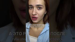 Не смотрись в зеркало - говорим пациенткам после увеличения губ, так как отек, асимметрия, гематомы