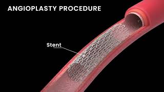 Best Treatment For Diabetic Swollen Feet