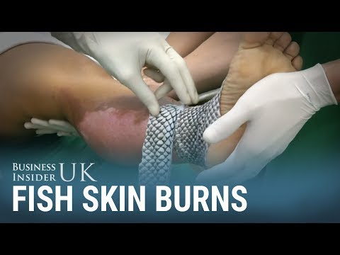 Brazilian doctors are using fish skin to treat burn victims – here's why