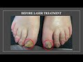 Fungal Nail Transformation With Laser Treatment